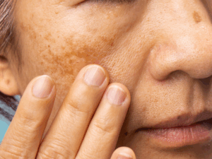 Quando procurar um especialista para tratar melasma em Porto Alegre