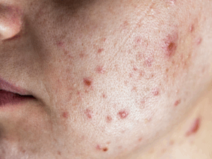 Dermatologista para cicatrizes de acne em Porto Alegre: conheça os tratamentos mais eficazes