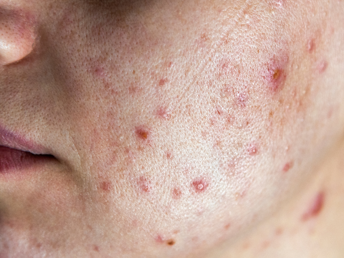 Dermatologista para cicatrizes de acne em Porto Alegre: conheça os tratamentos mais eficazes