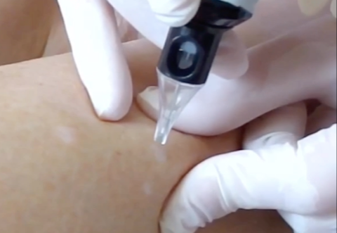 Microinfusão de Medicamentos na Pele - Francine Costa